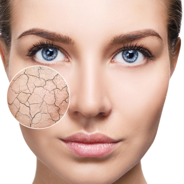 Dry Skin