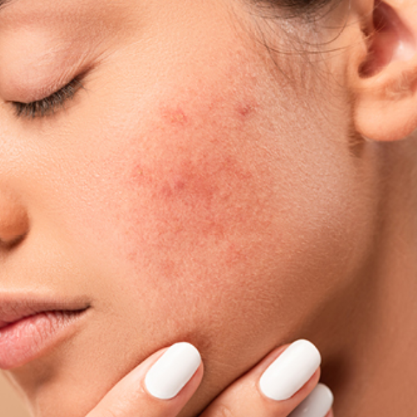 Acne & Blemishes