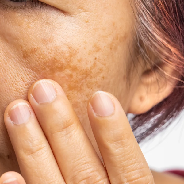 Hyperpigmentation
