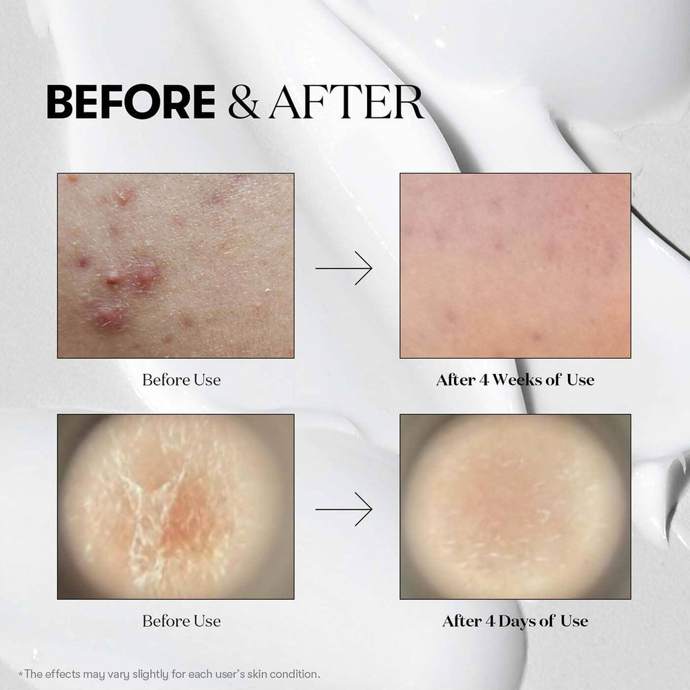 Cica Hyalon Reedle Shot 100 Essence 50ml how to use