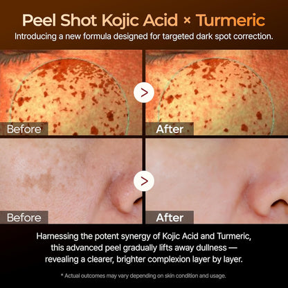 Peel Shot Exfoliating Kojic Acid Turmeric Serum – 80ml