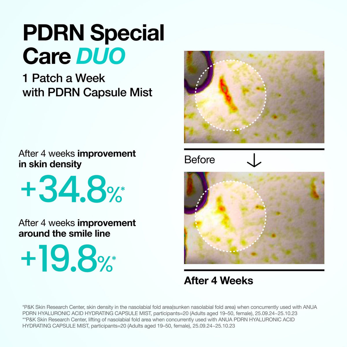 Anua PDRN Collagen Melting Patch applied on smile lines